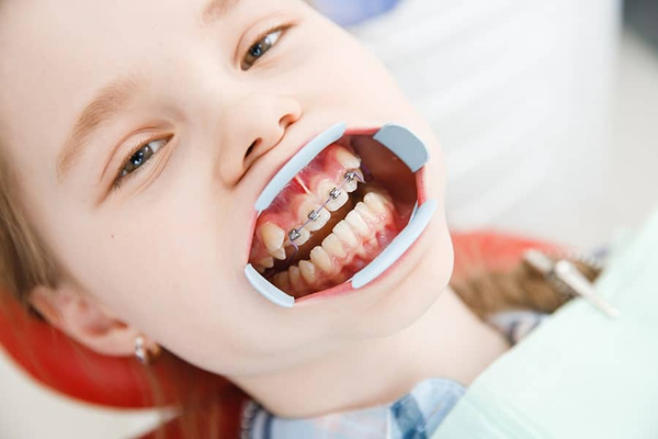 traditional braces in glendale