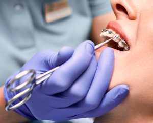 WildSmile Braces Adjustment
