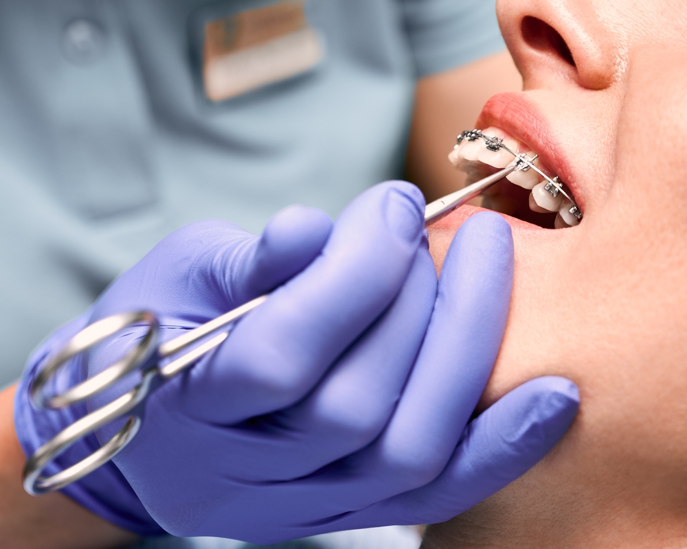 WildSmile Braces Adjustment