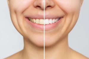 Teeth Whitening and Sensitivity