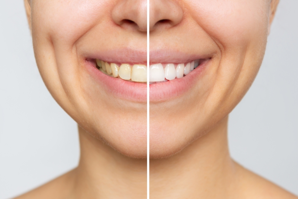 Teeth Whitening and Sensitivity