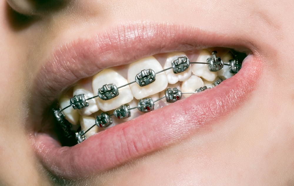 what are dental braces, and what are the different types of dental braces