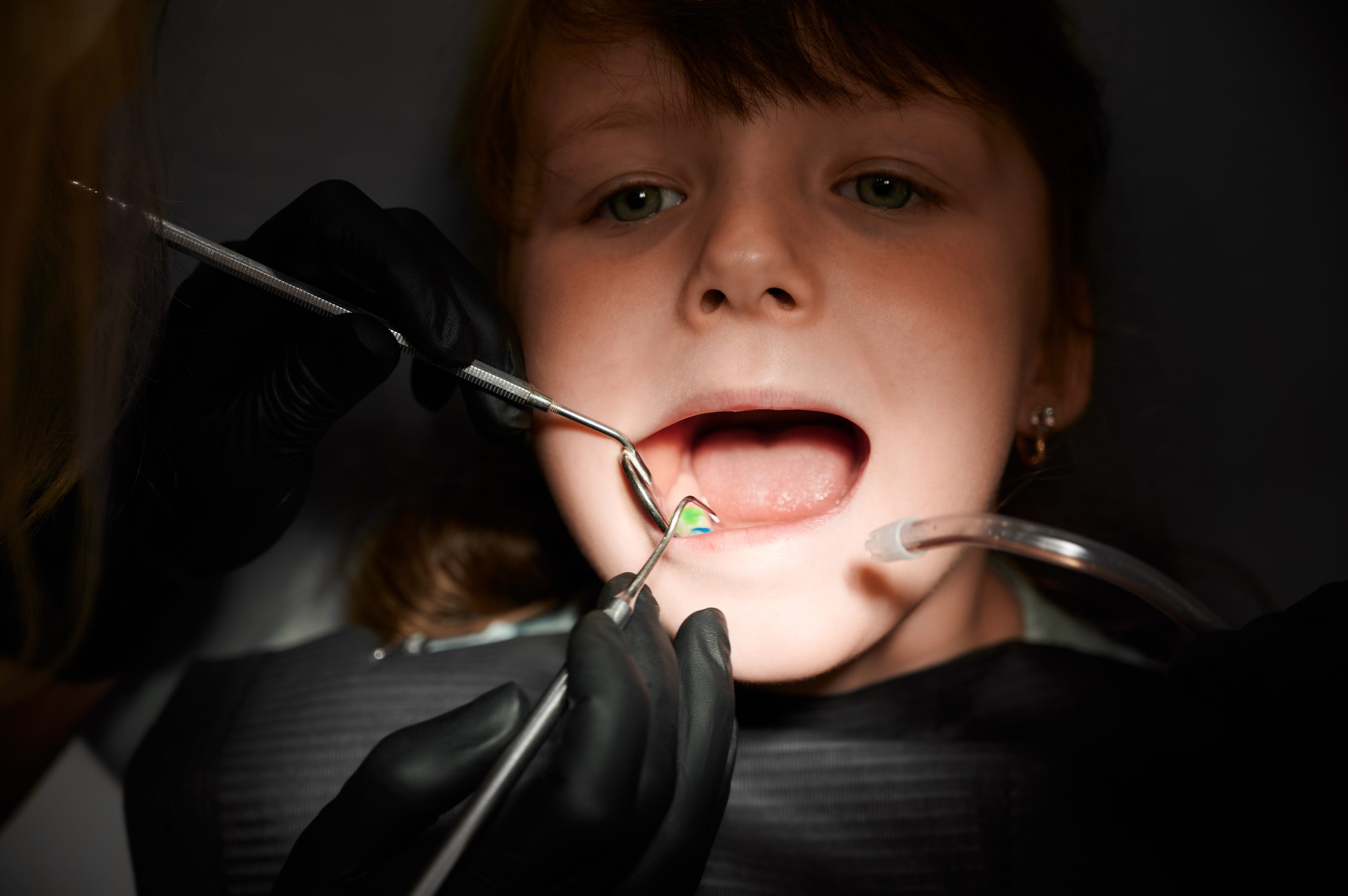 Do Dentists Still Recommend Sealants