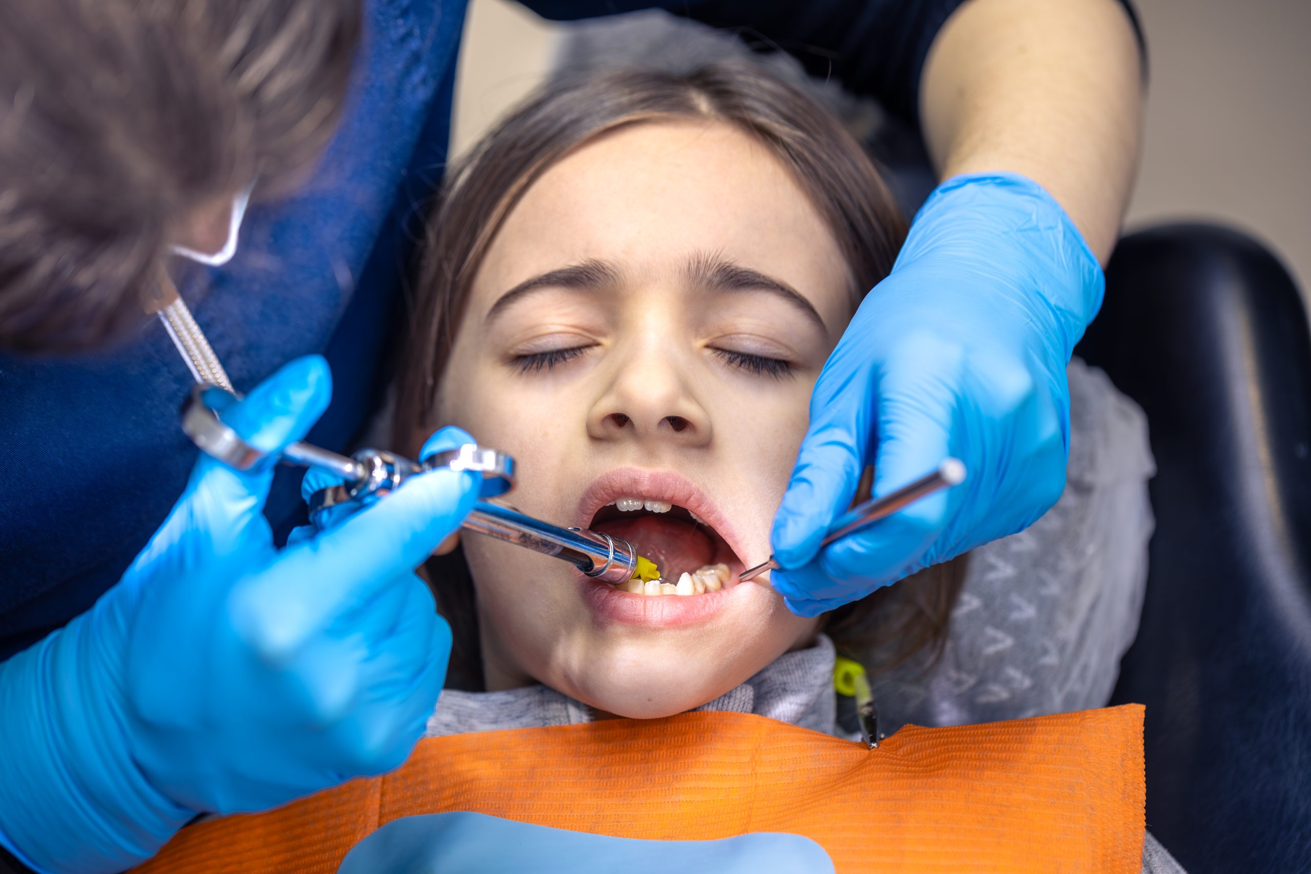 How Do Tooth-Colored Fillings Treat Cavities in Children?